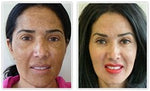 Cosmelan Intense De-pigmenting Peel