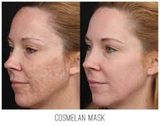 Cosmelan Intense De-pigmenting Peel