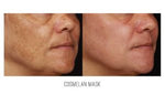Cosmelan Intense De-pigmenting Peel