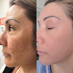 Cosmelan Intense De-pigmenting Peel